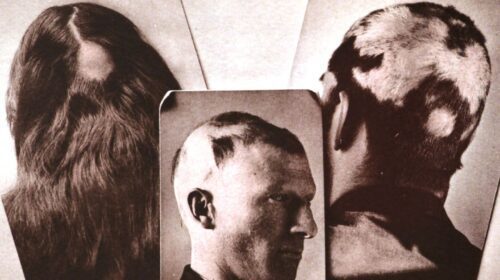 Alopezie