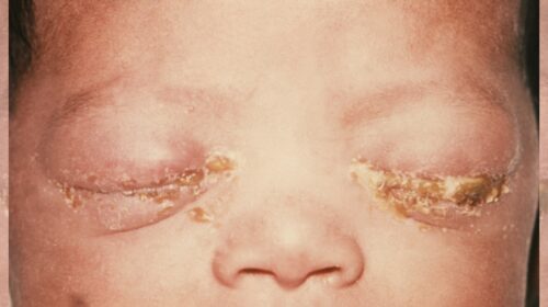 Betroffene Augen