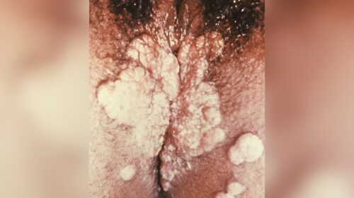 Condylomata lata der Vulva