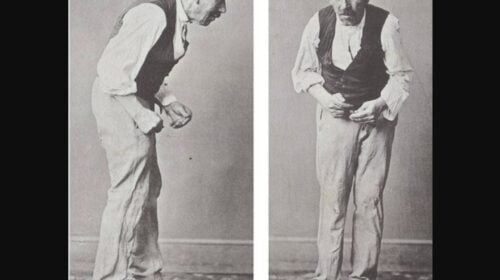 Parkinson Patient 