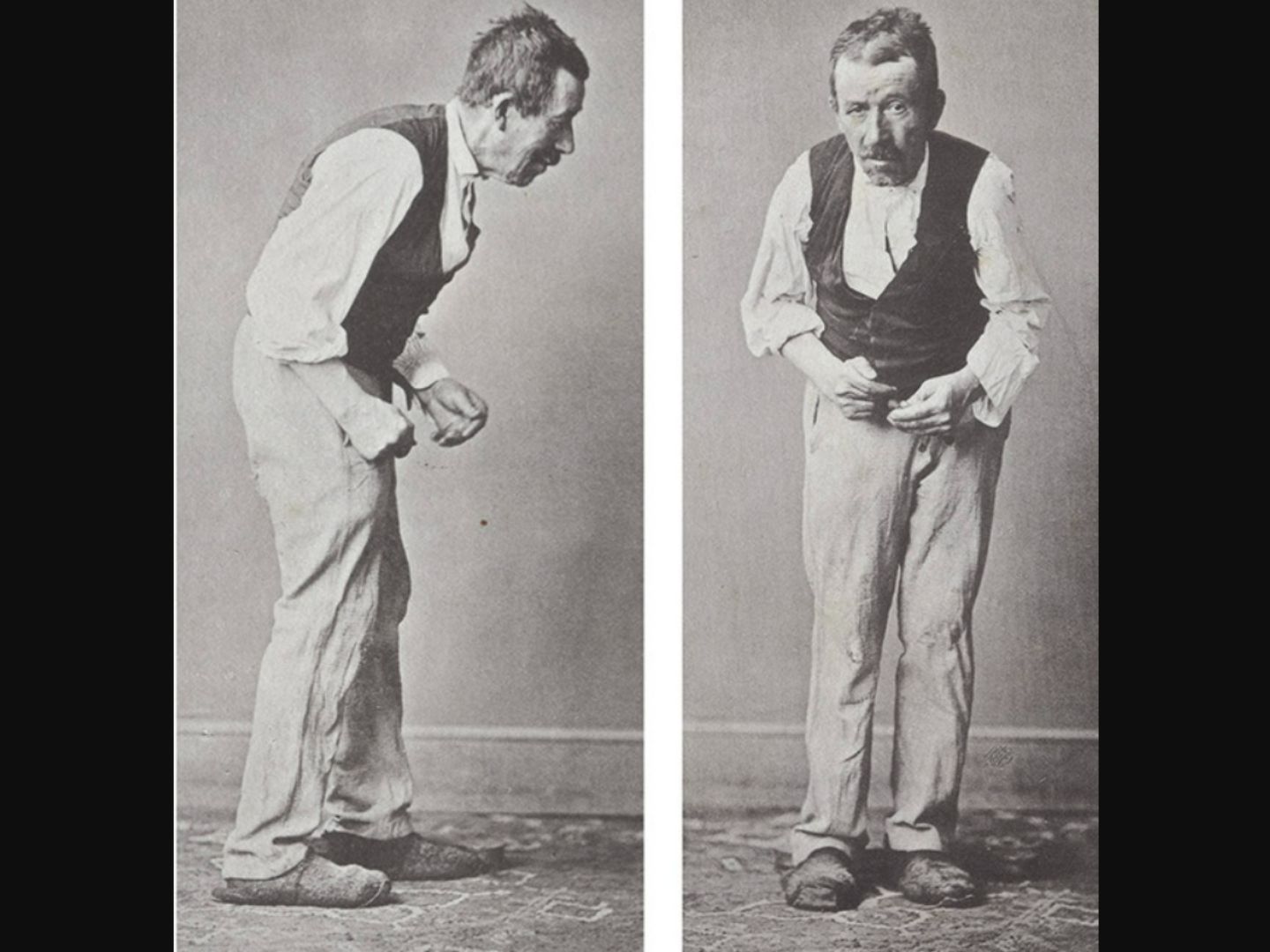 Parkinson Patient
