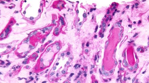 Histo Cast-Nephropathie
