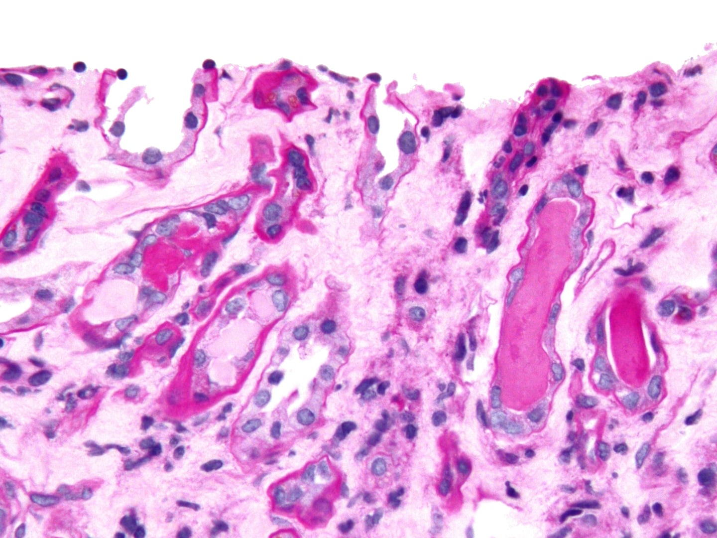 Histo Cast-Nephropathie