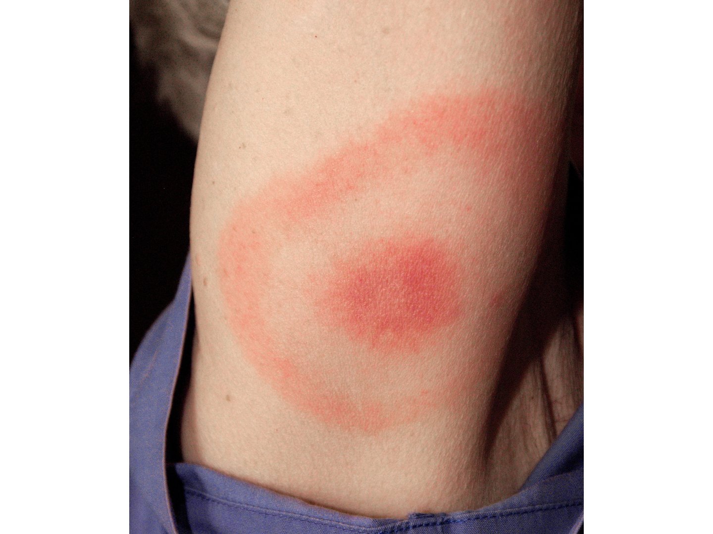Erythema migrans