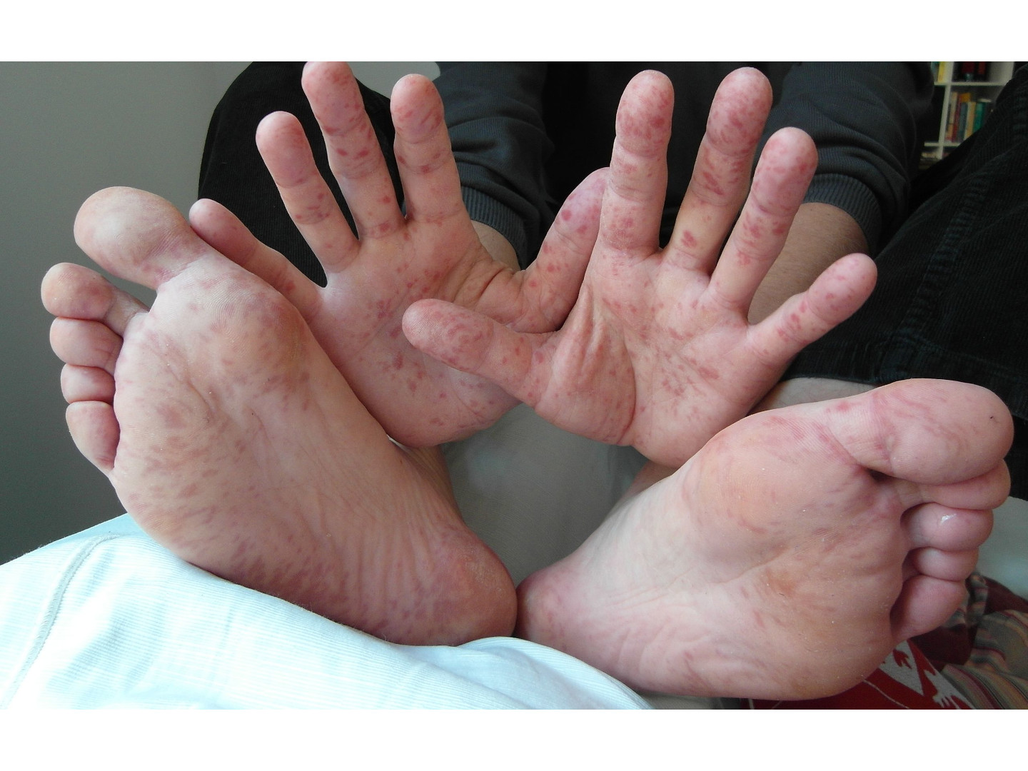 HAND-FUSS-Mund-Krankheit