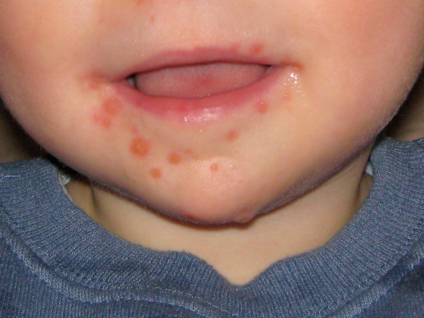 Hand-Fuß-MUND-Krankheit