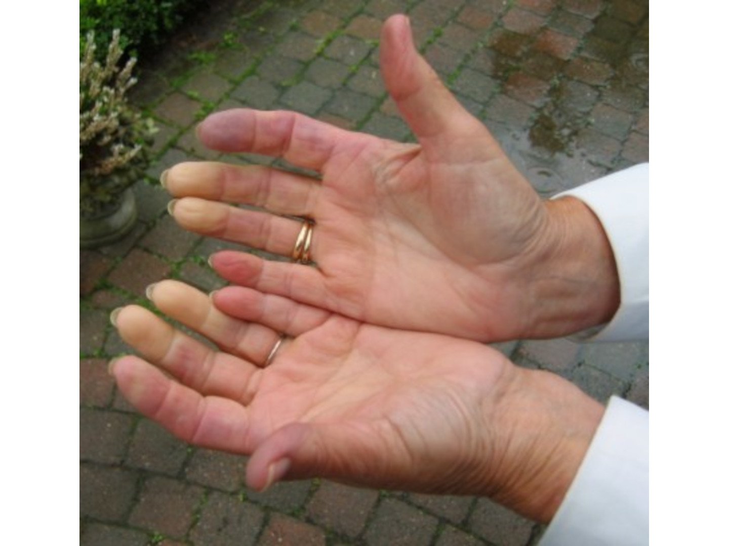 Sekundäres Raynaud-Syndrom