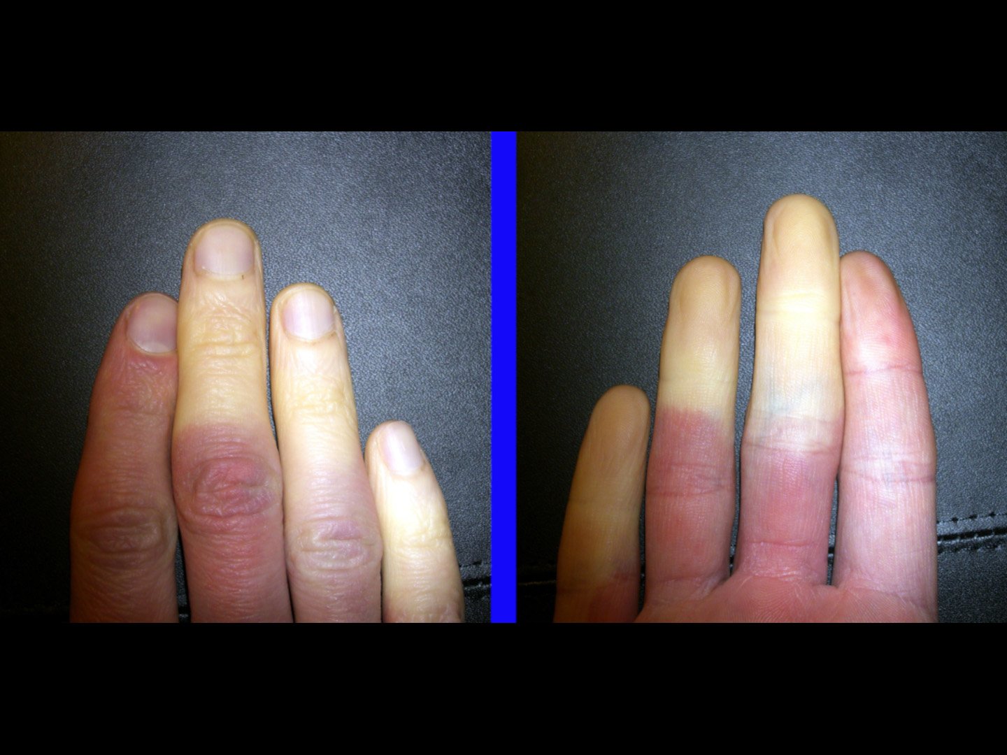 Ischämie der Finger