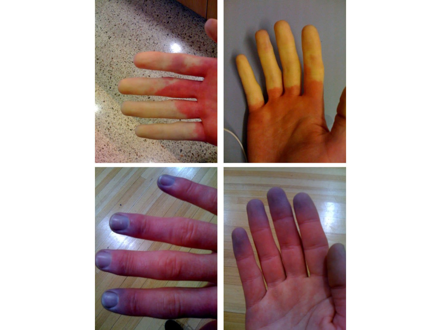 Überblick Raynaud-Phänomen