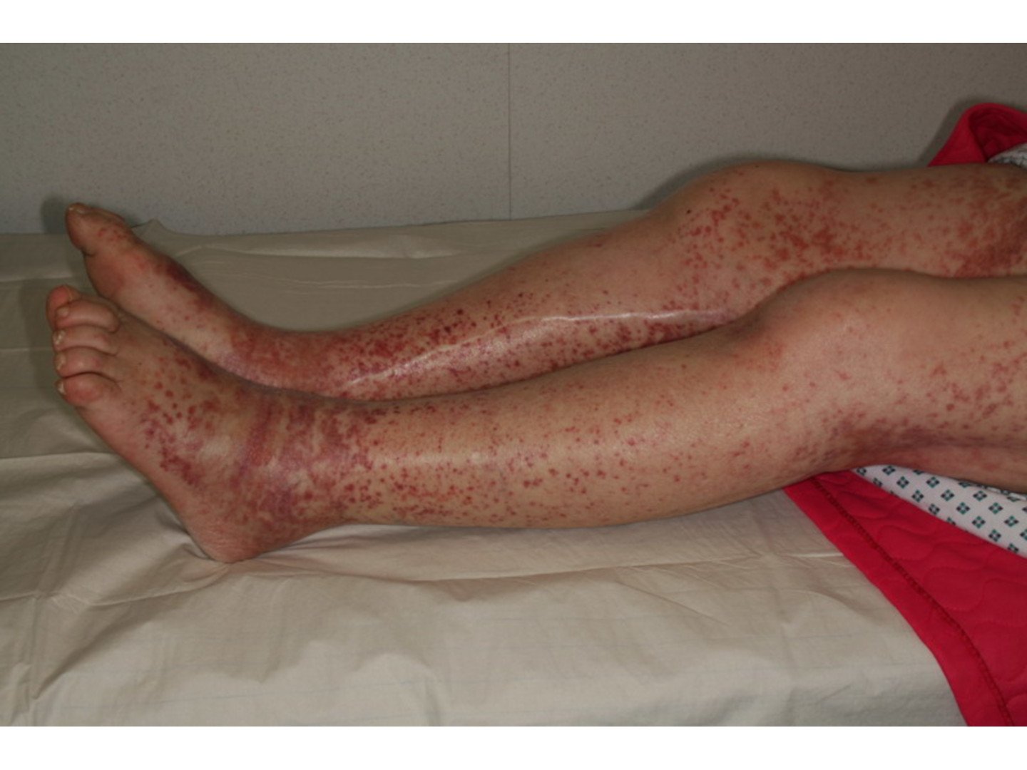 Palpable Purpura