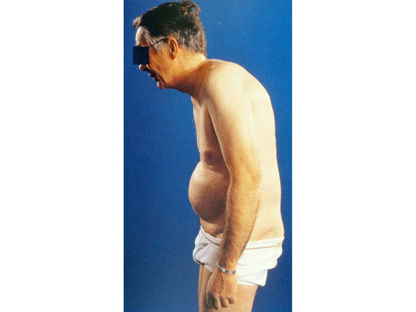 Klinisches Bild einer fixierten Kyphose 