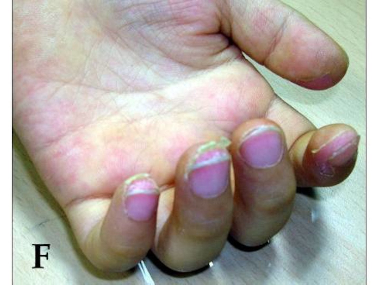 Halbmondförmige Schuppung der Fingerspitzen