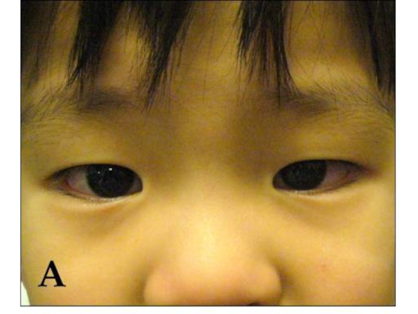 Bilaterale Konjunktivitis