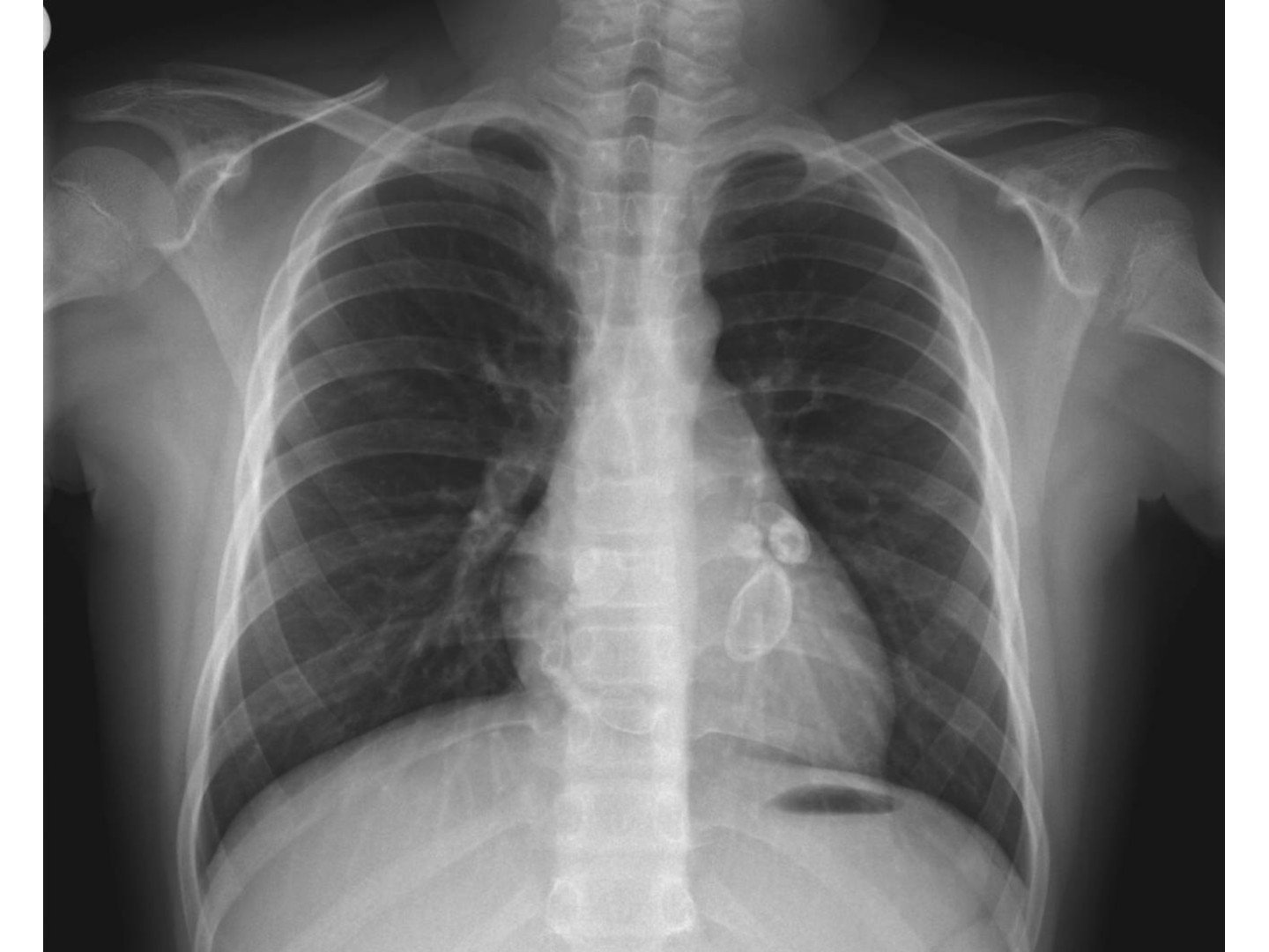 Aneurysmen der Herzkranzgefäße