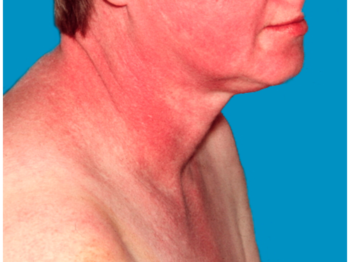 Erythem in Gesicht und De­kolle­té