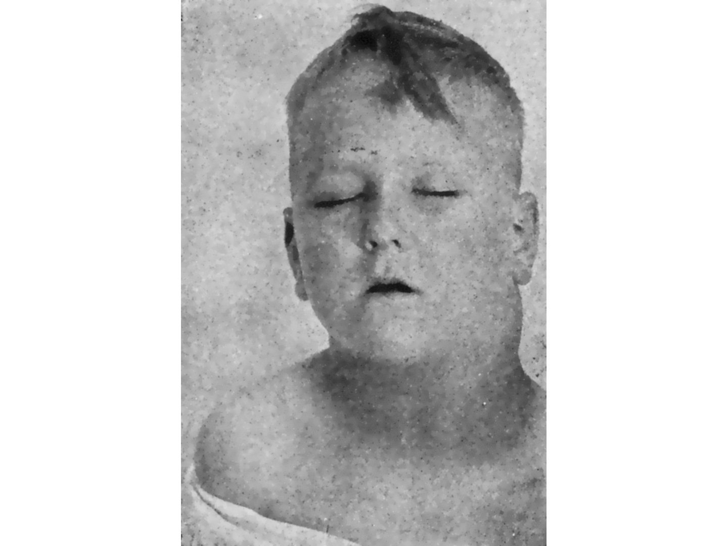 Zervikale Lymphadenopathie