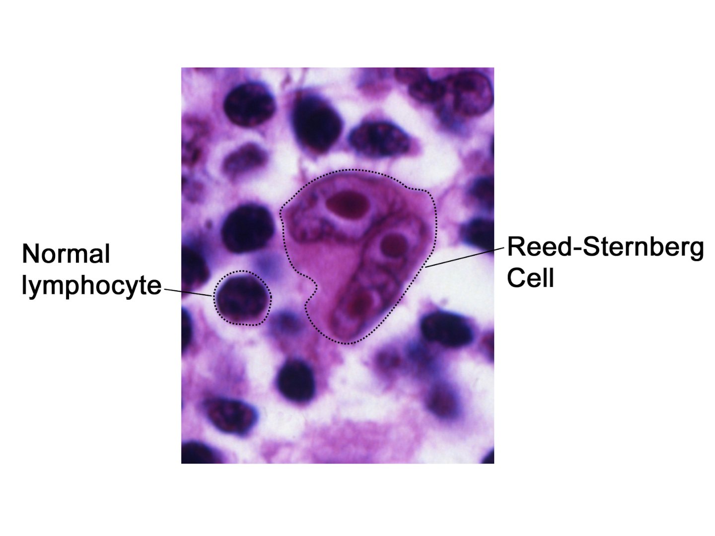 Reed-Sternberg-Zelle