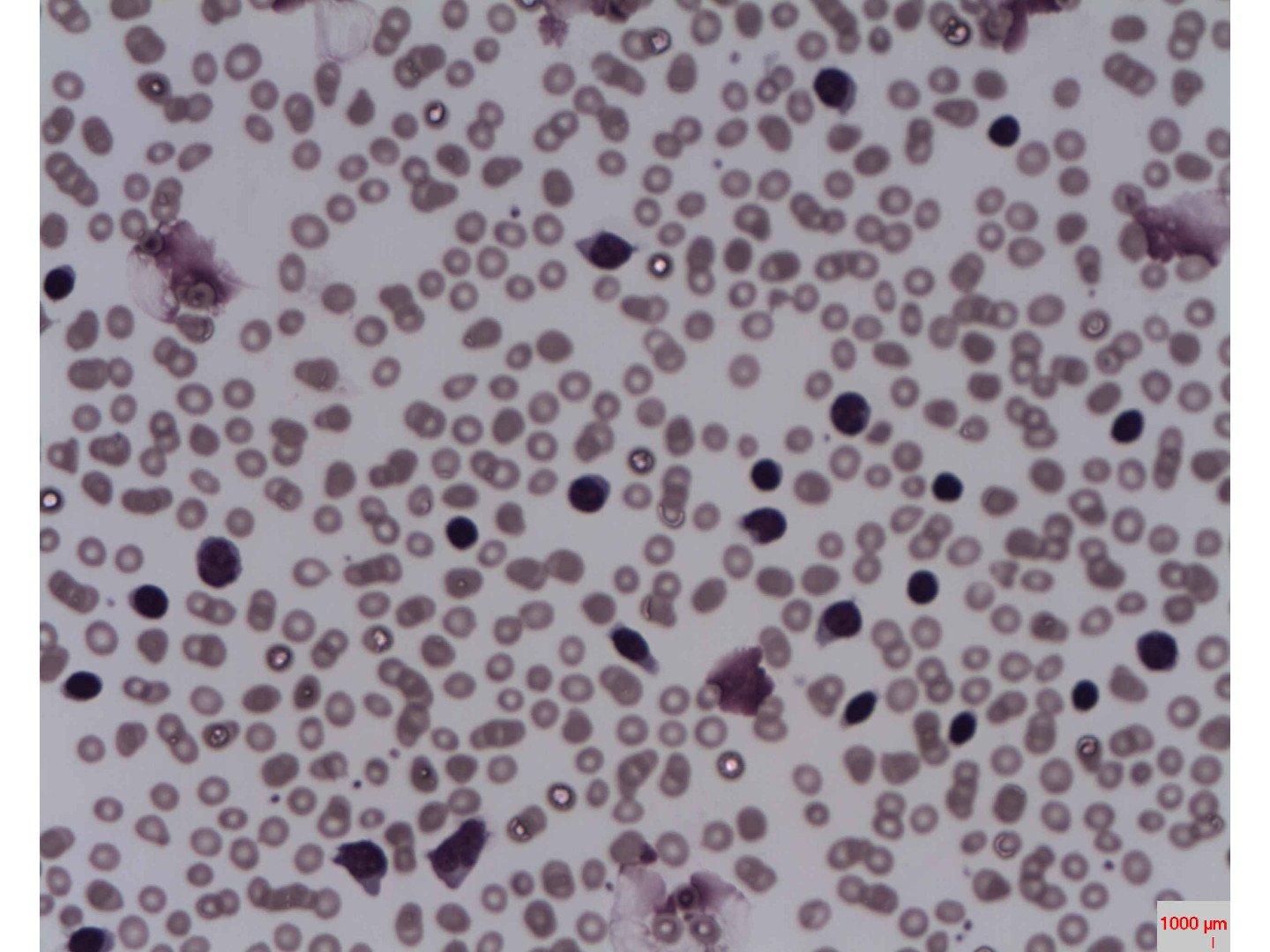 Gumpertsche Kernschatten im Blutausstrich