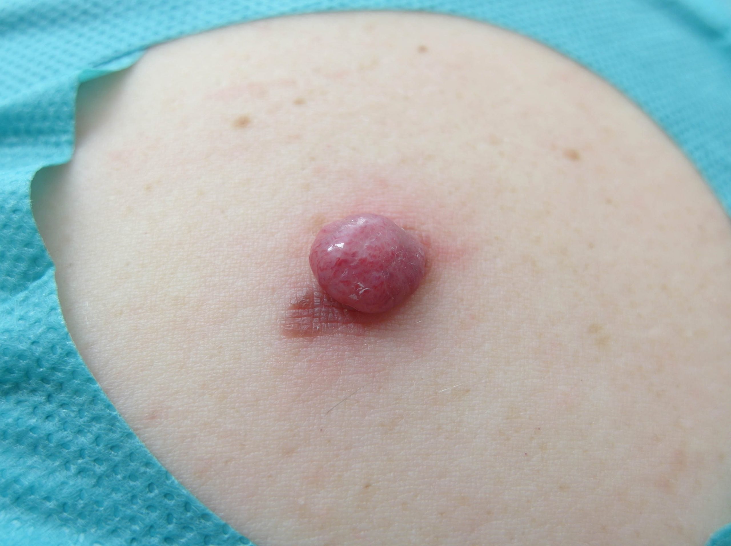 Amelanotisches Melanom