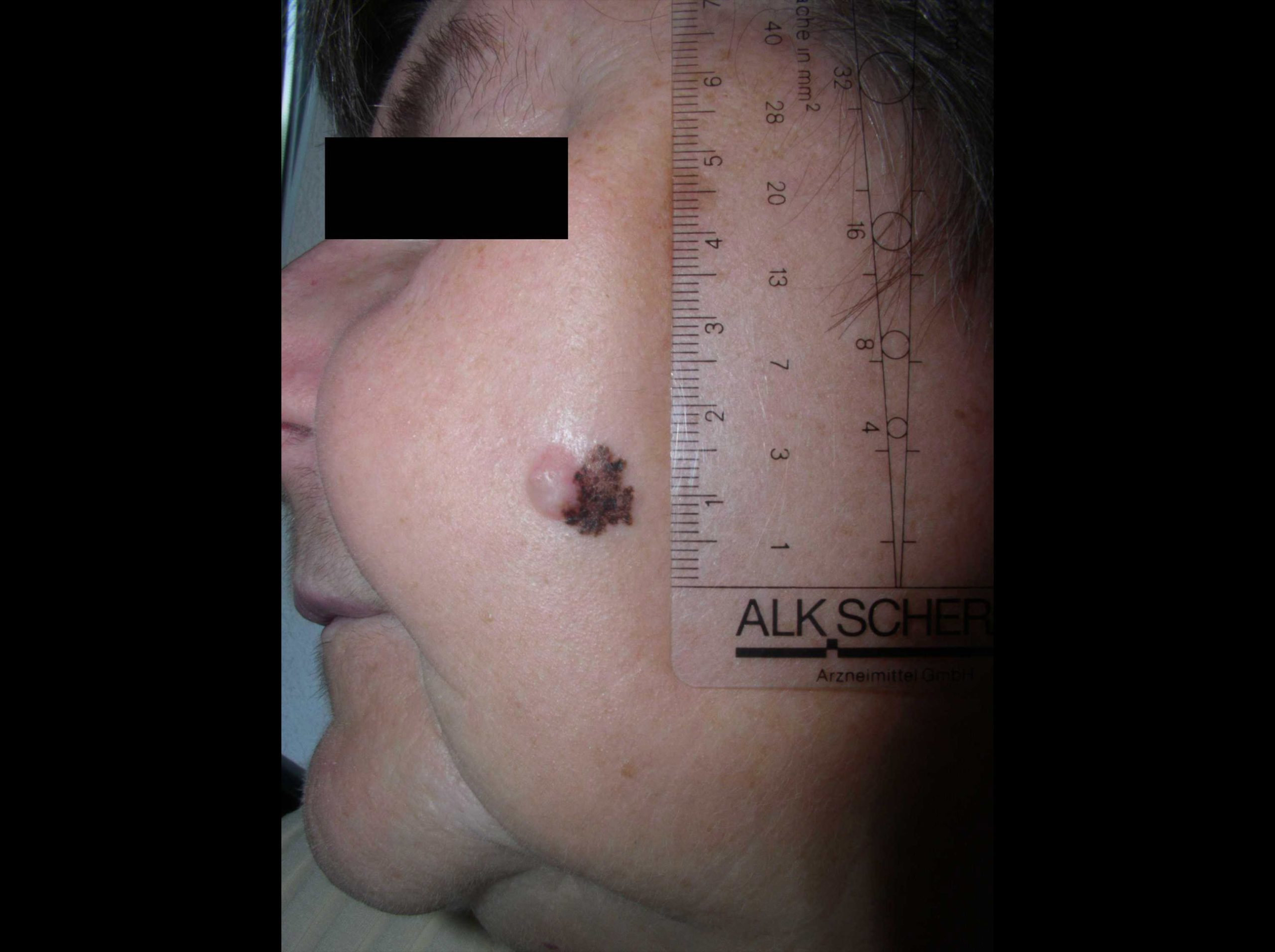 Oberflächlich spreitendes malignes Melanom