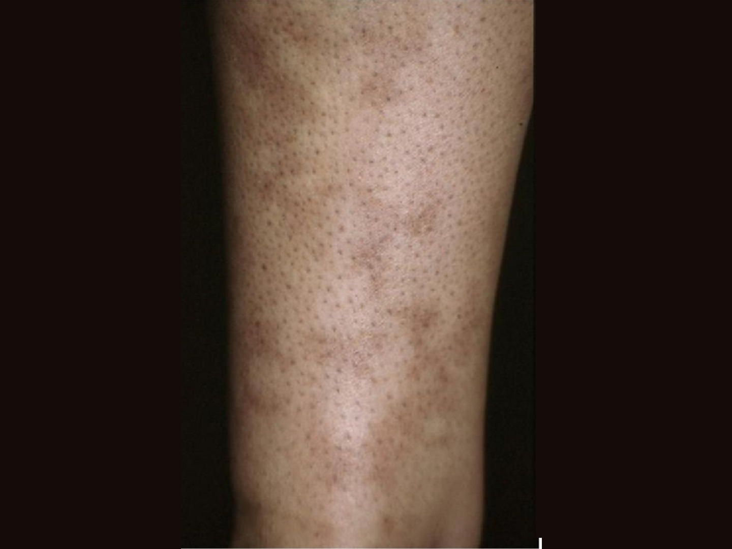 Livedo reticularis