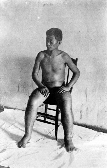 “Nasse“ Beri Beri: Herzinsuffizienz