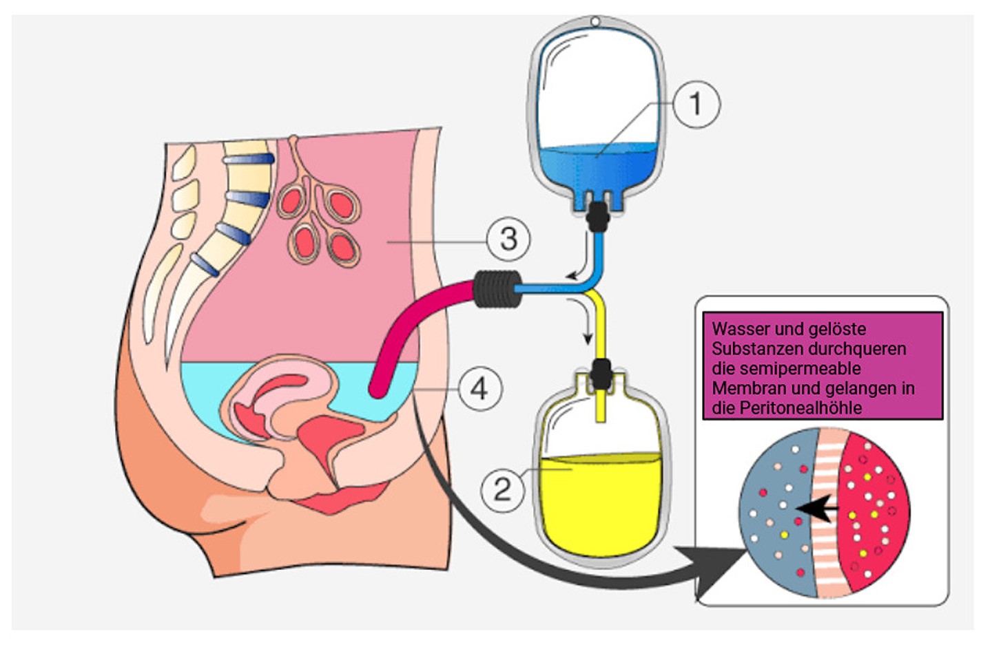 Peritonealdialyse