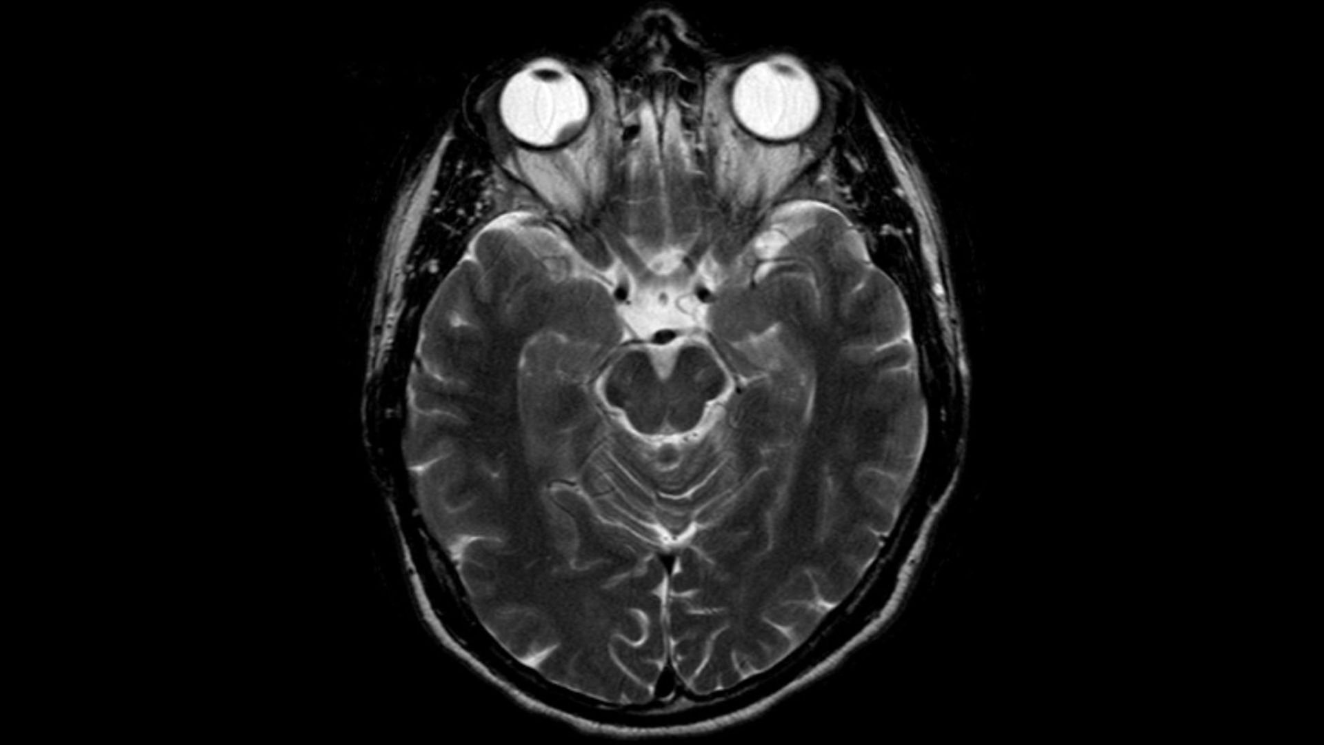 Aderhautmelanom im MRT