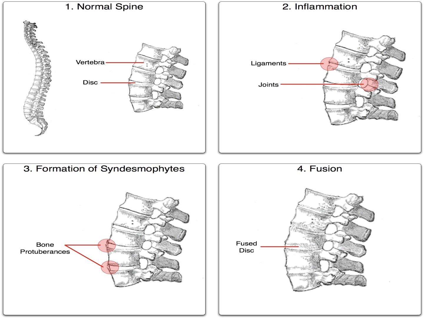 Ankylosierende Spondylitis
