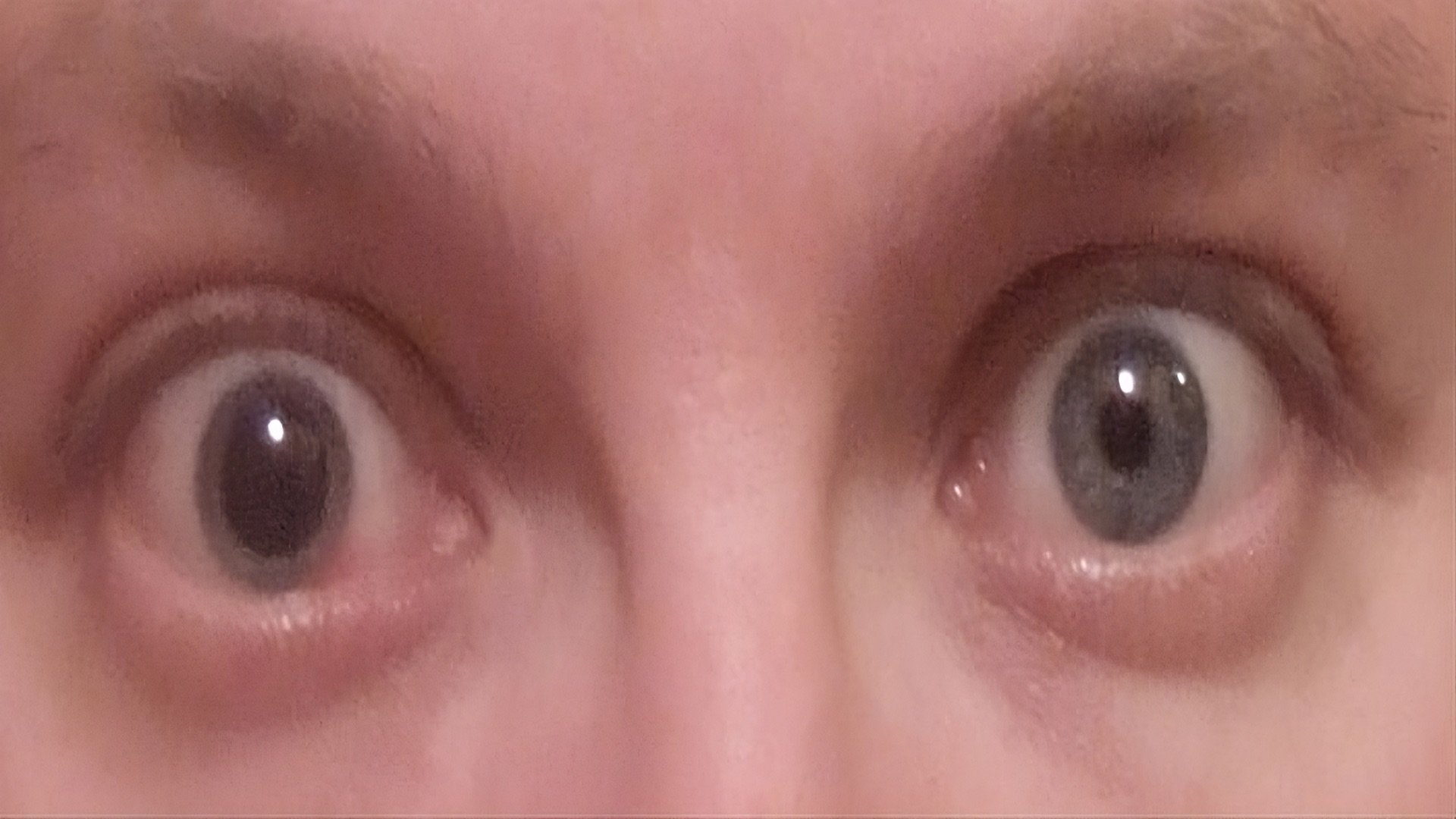 Atropin-induzierte Mydriasis