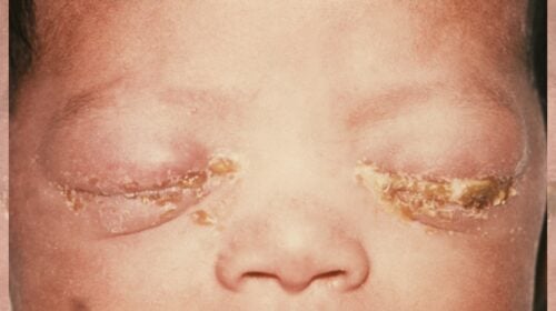 Betroffene Augen