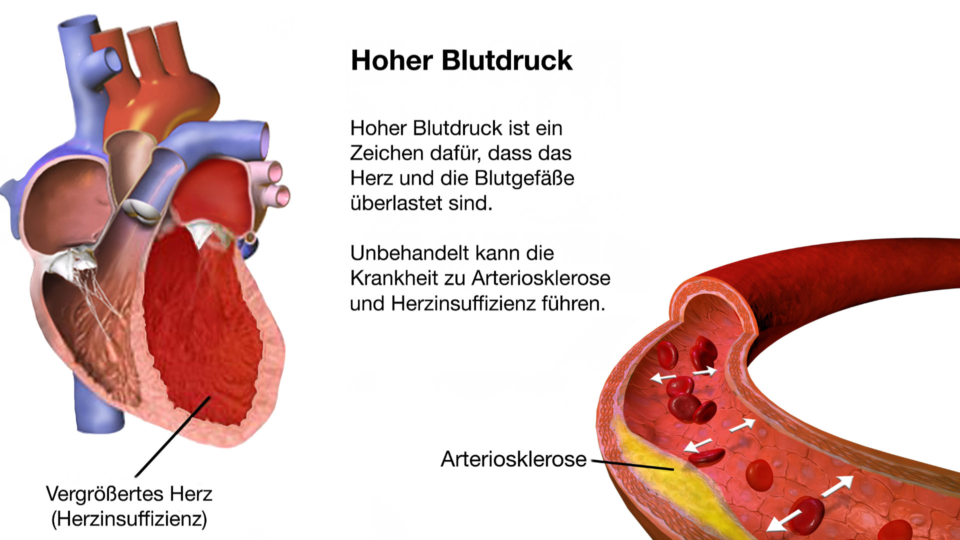 Konzentrische Größenzunahme des linken Ventrikels.