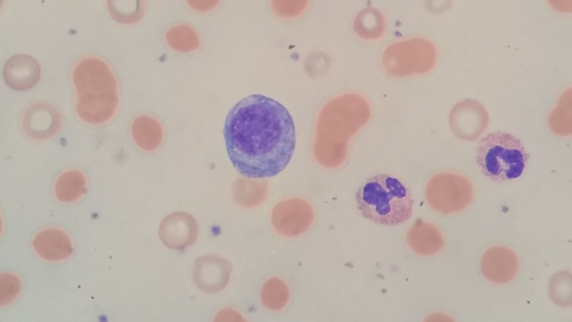 Blutausstrich Multiples Myelom 
