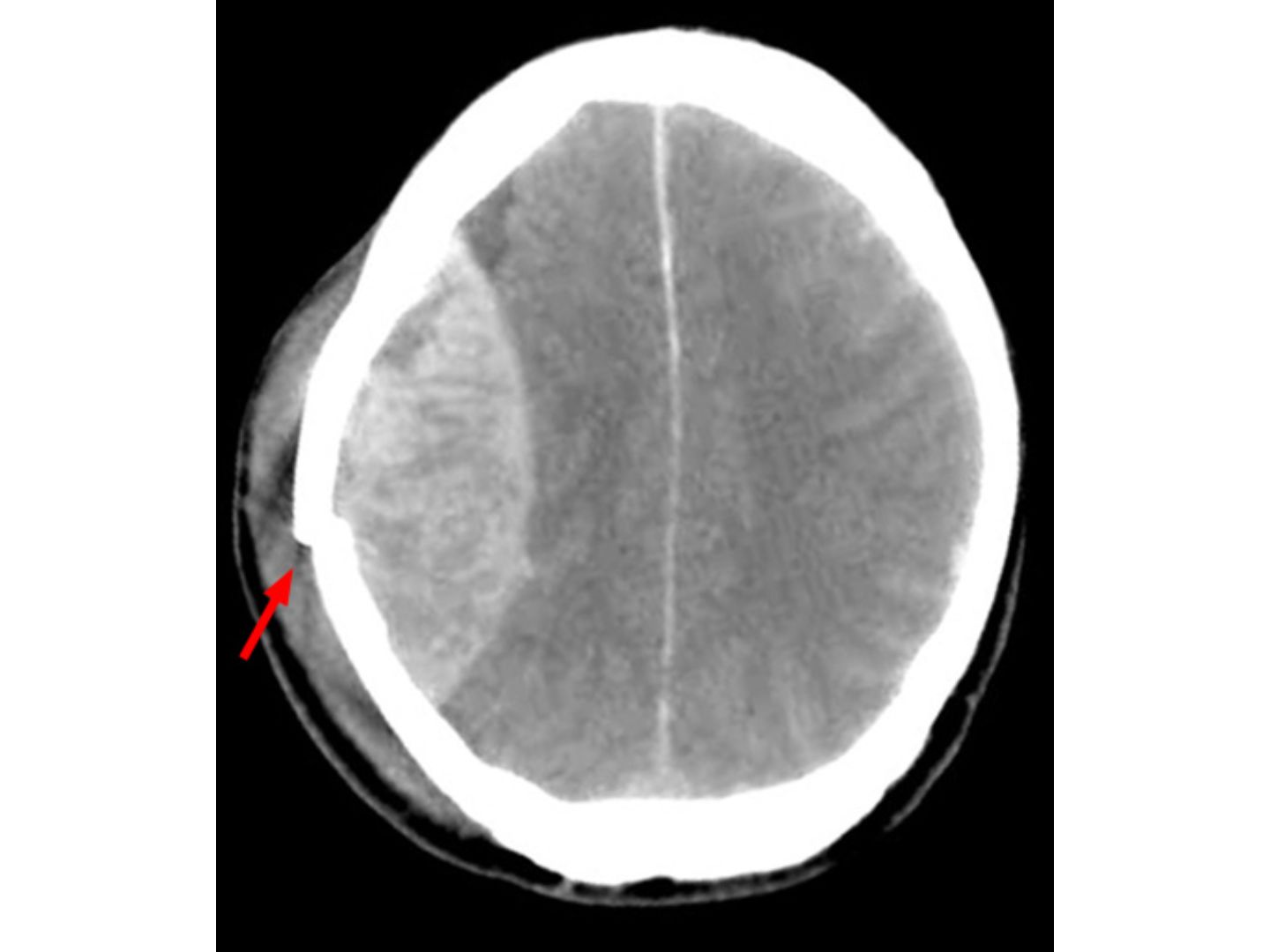 CCT: Epidurales Hämatom