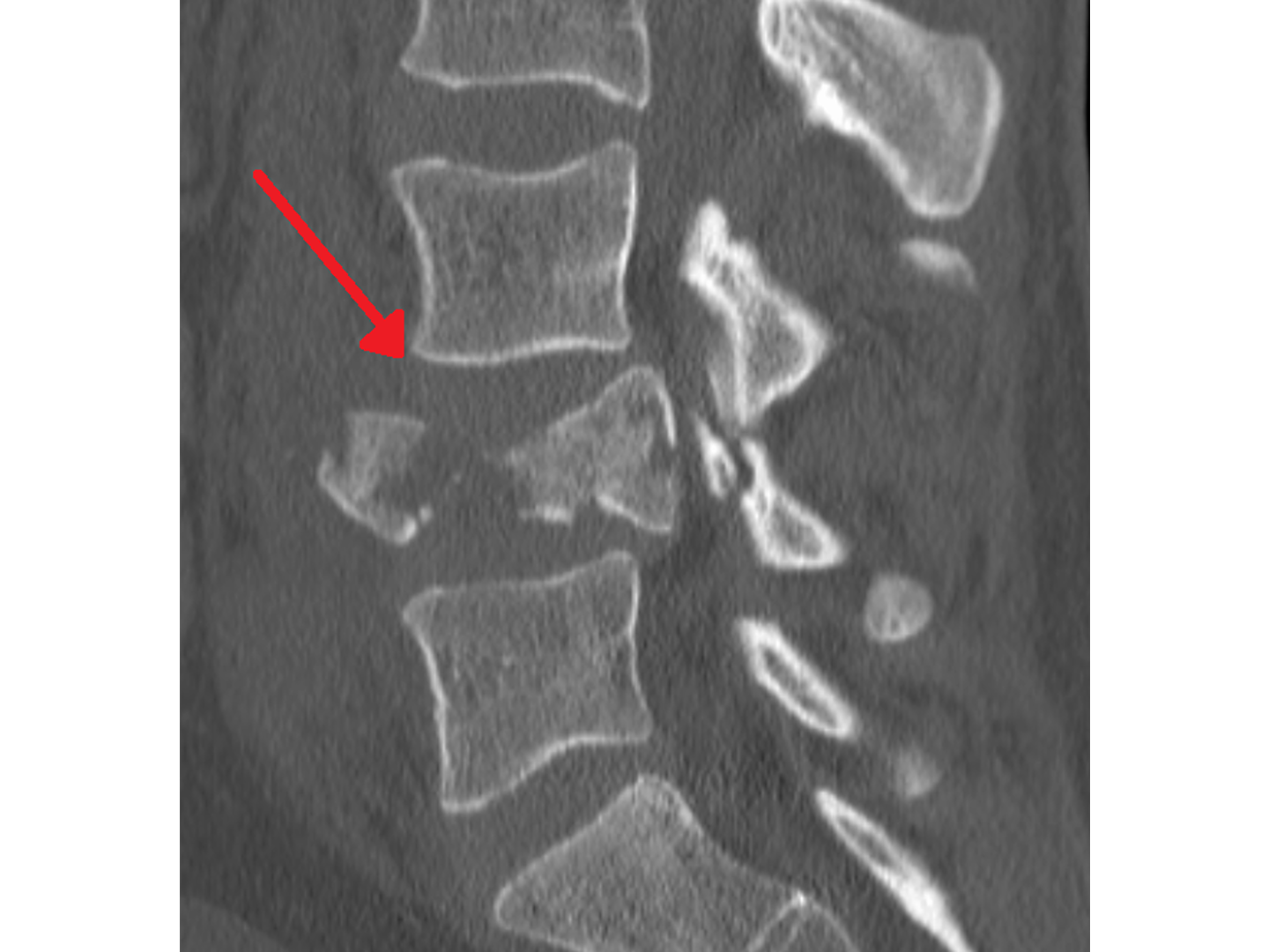 CT: Typ A Burst-Fraktur