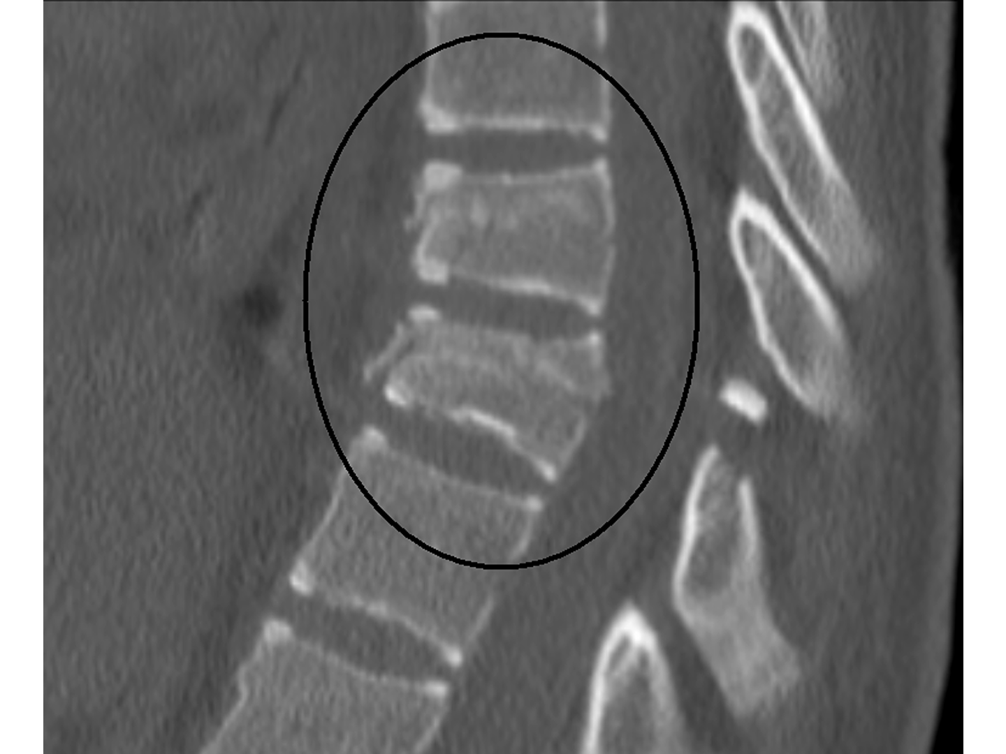 CT: Typ B Chance-Fraktur