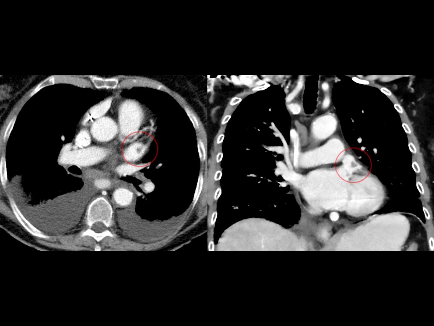 CT Vorhofthrombus