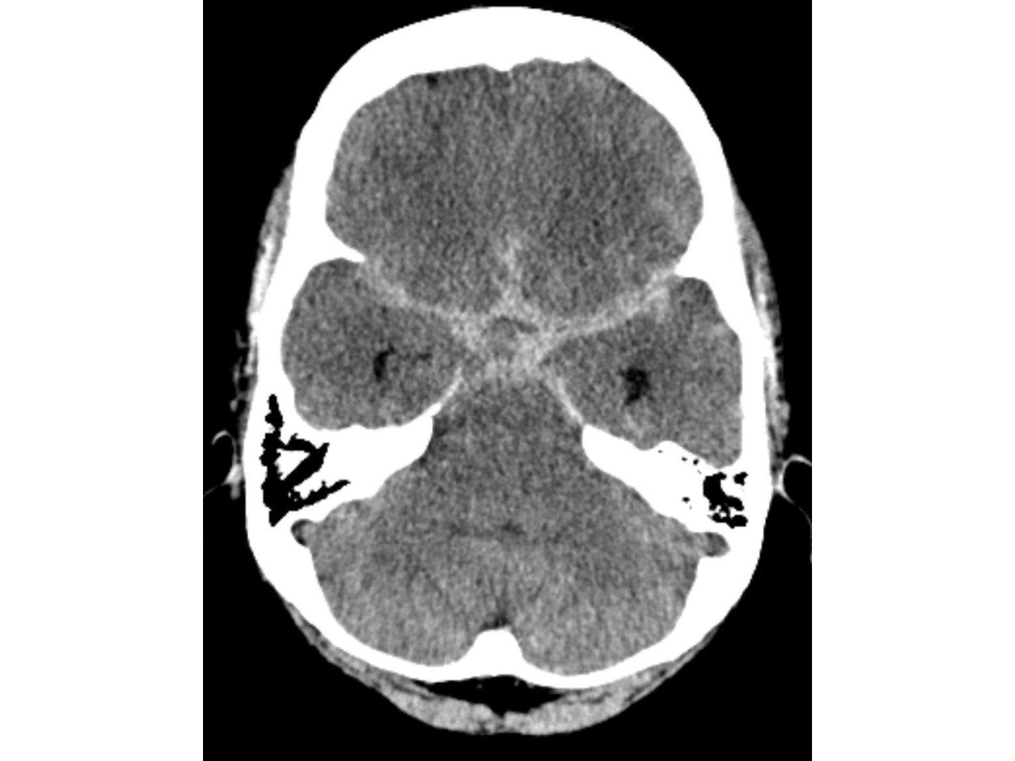 CTT: Subarachnoidale Blutung