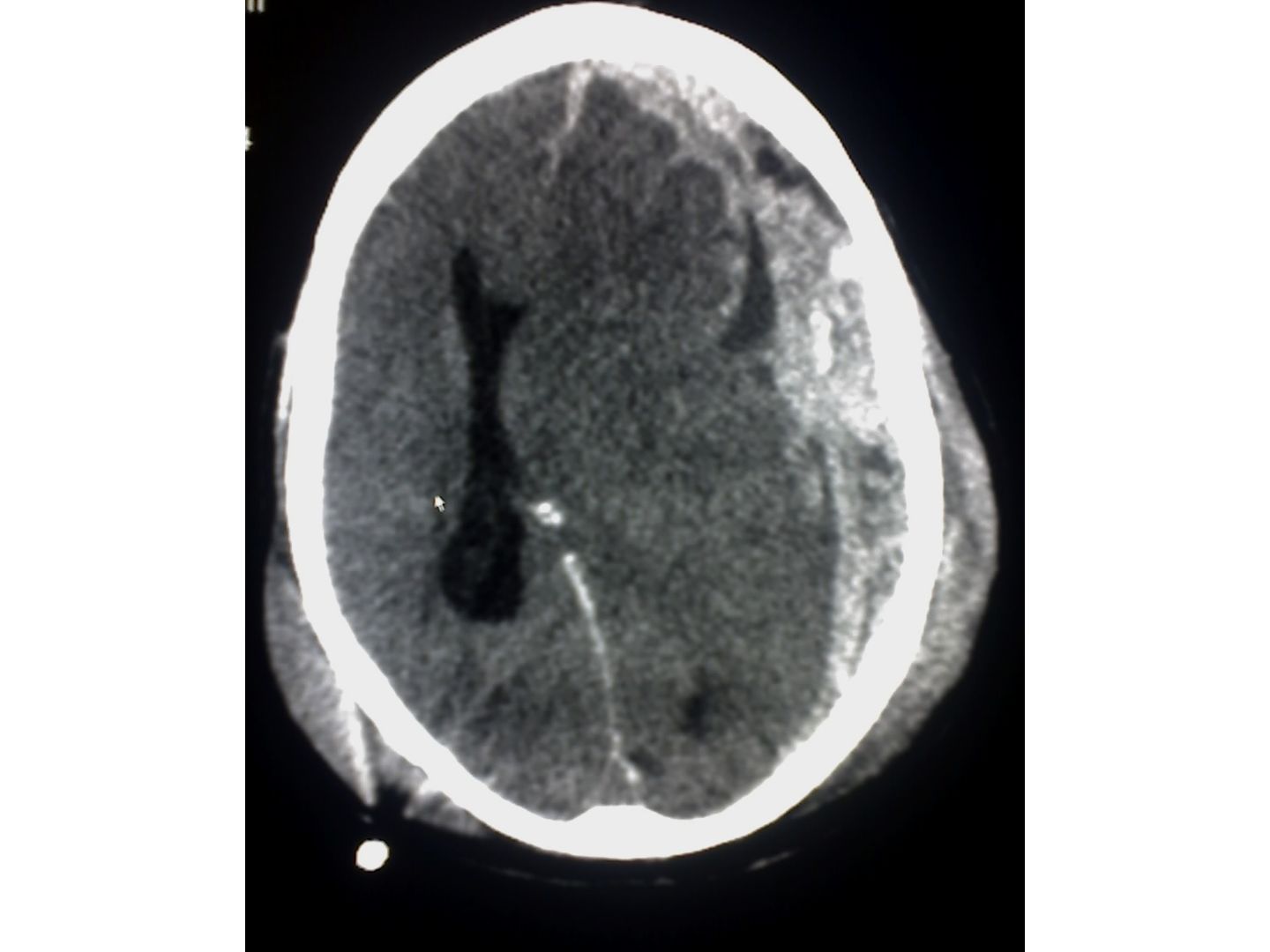 CTT: Subdurales Hämatom