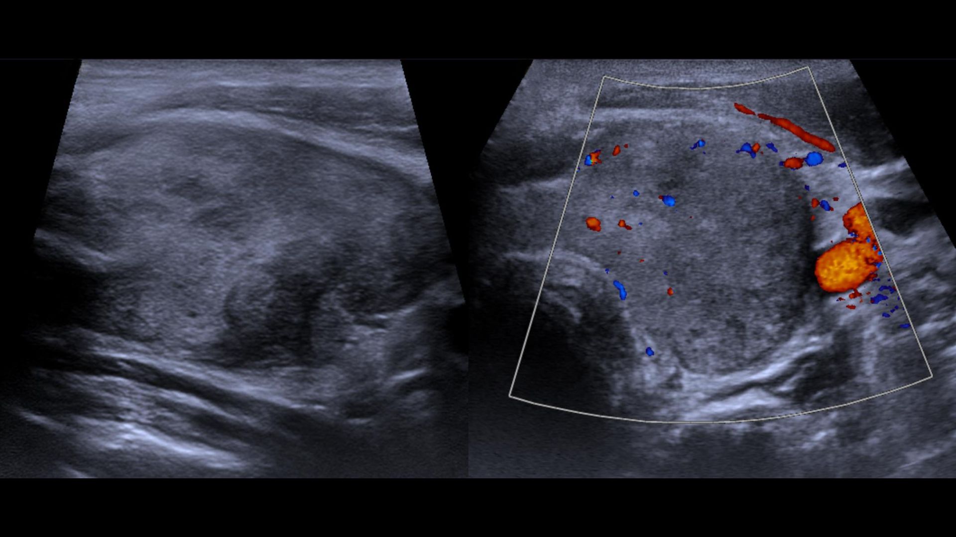 Doppler Thyreoiditis