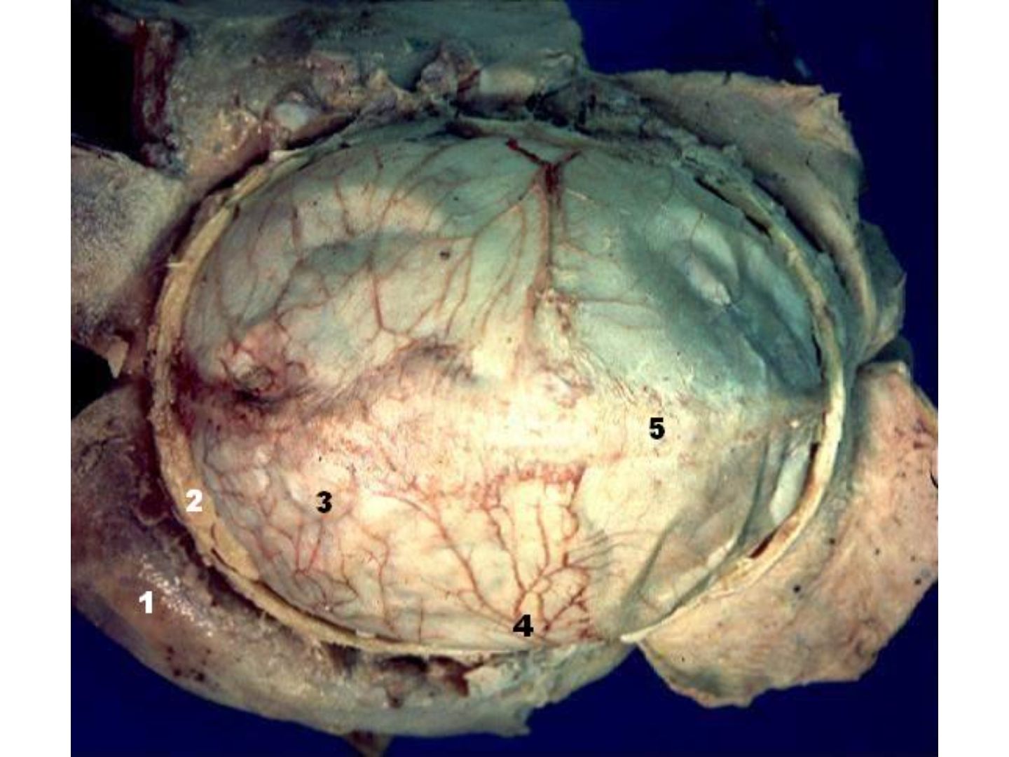 Dura mater