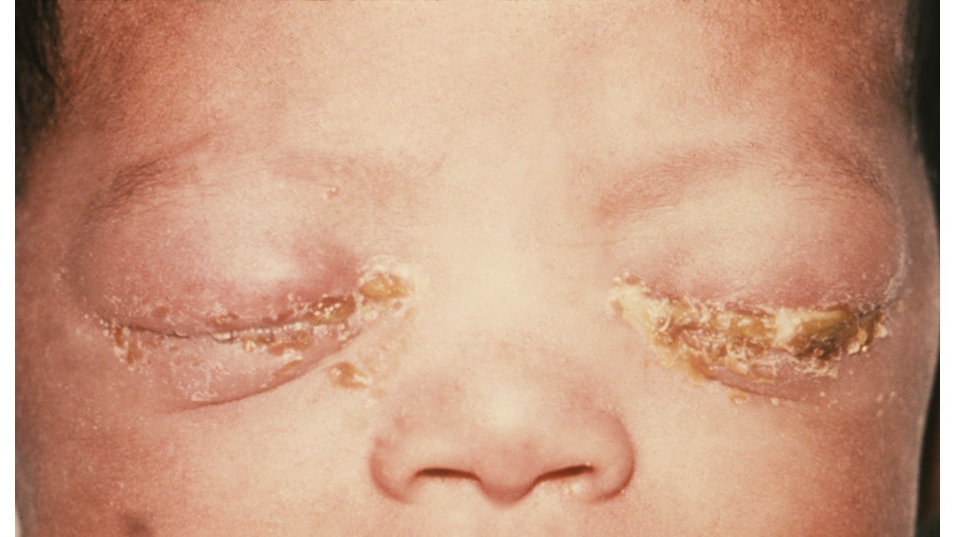 Gonokokken-Konjunktivitis bei einem Neugeborenen