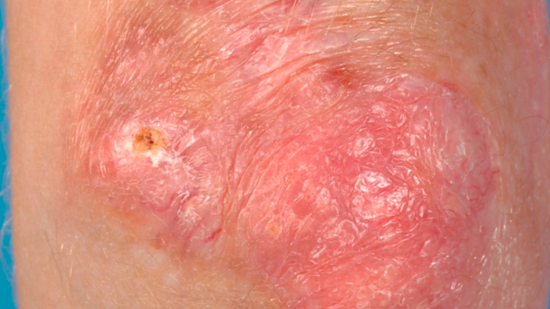 Gottron-Papeln am Ellenbogen