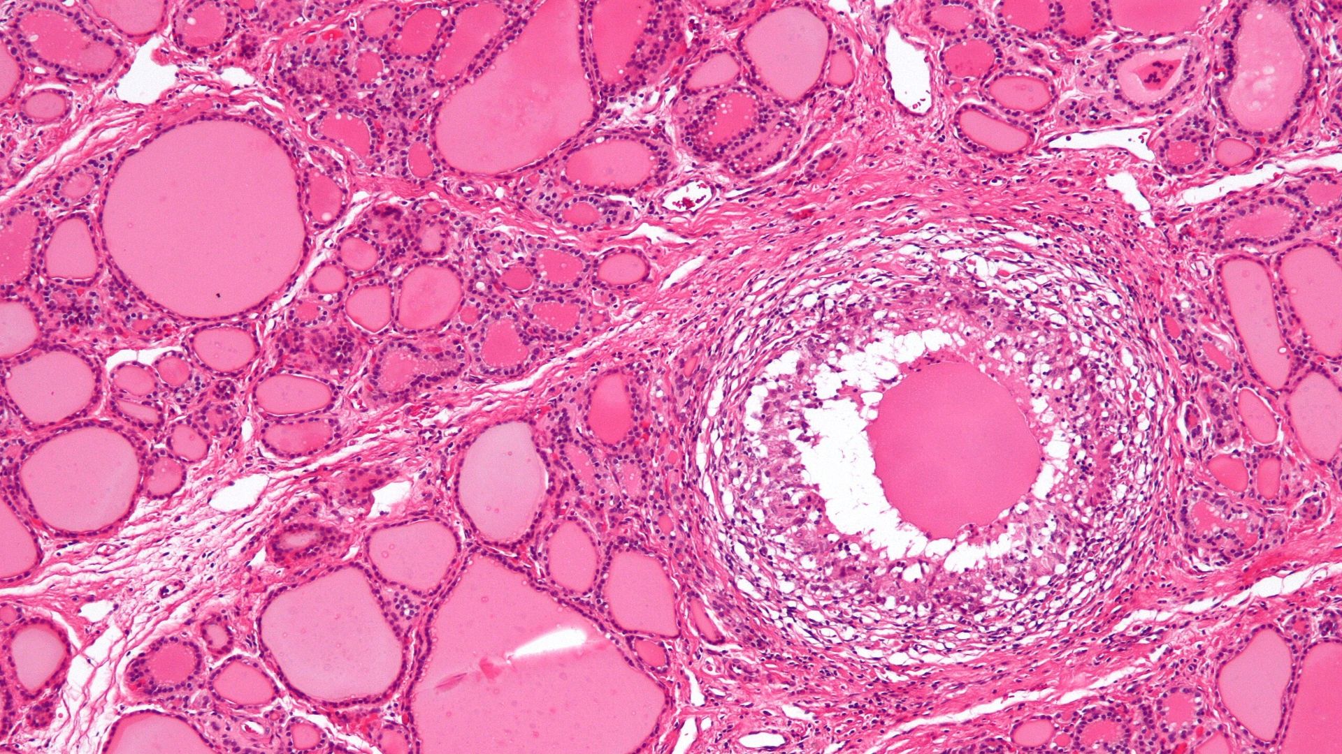 Granulome und Riesenzellen