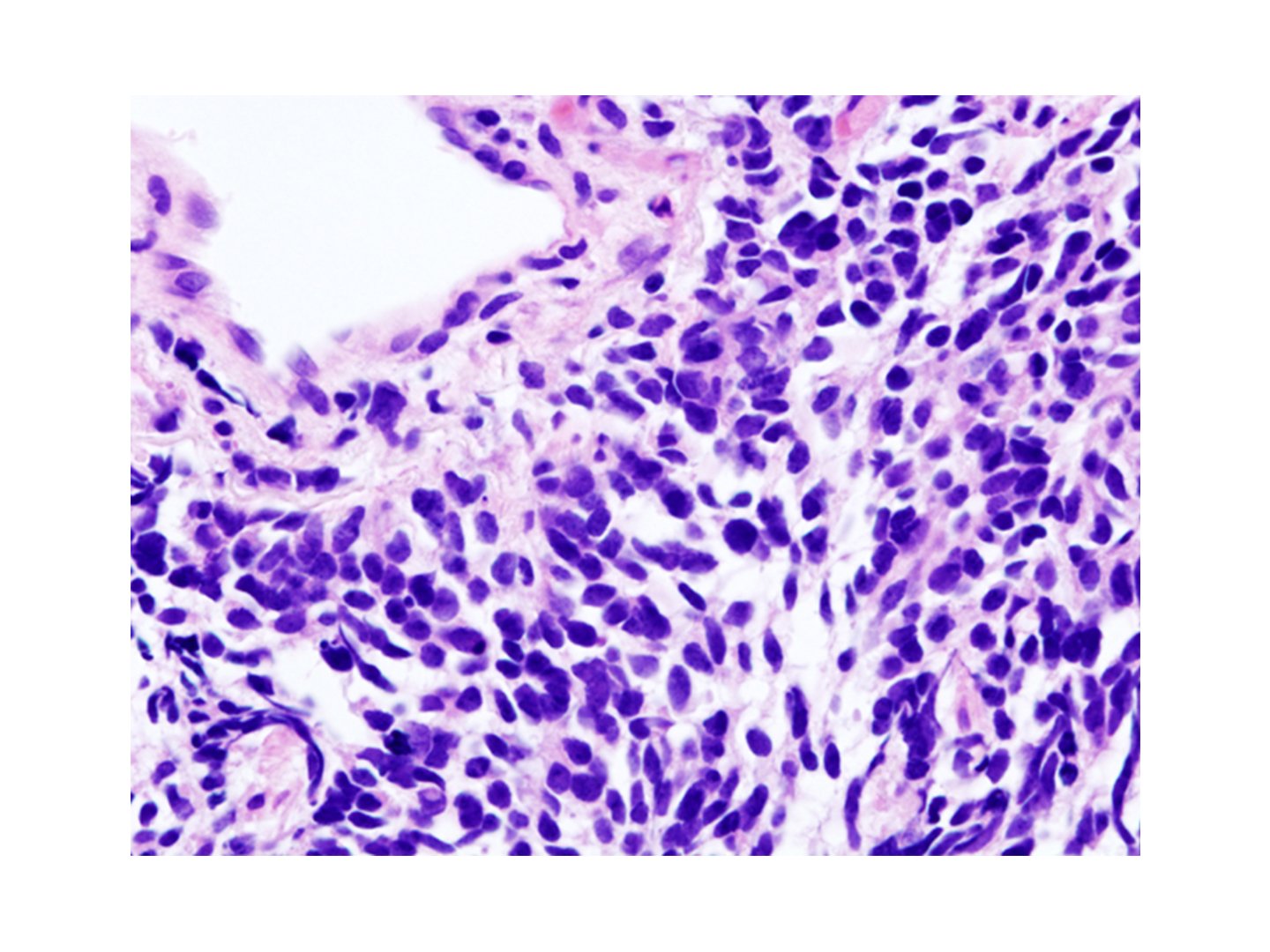 Kleinzelliges Lungenkarzinom