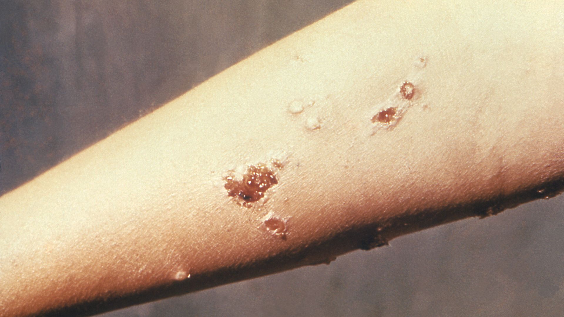 Impetico contagiosa