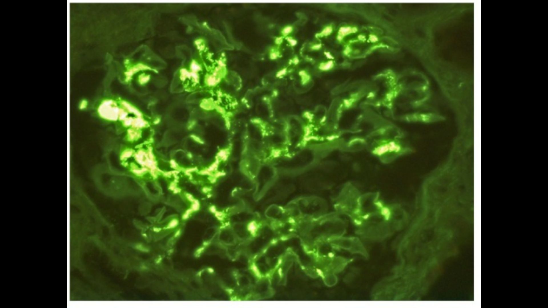 Lichtmikroskopisches Bild einer mesangialen Proliferation bei IgA-Nephropathie