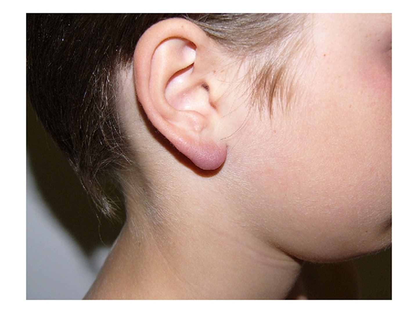 Lymphadenosis cutis benigna 