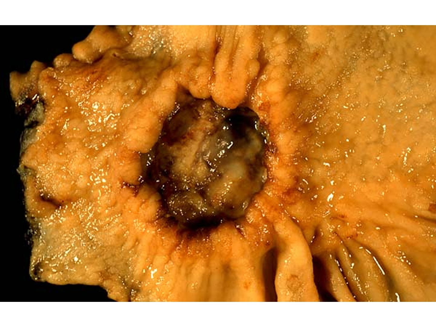 Magenkarzinom Resektat