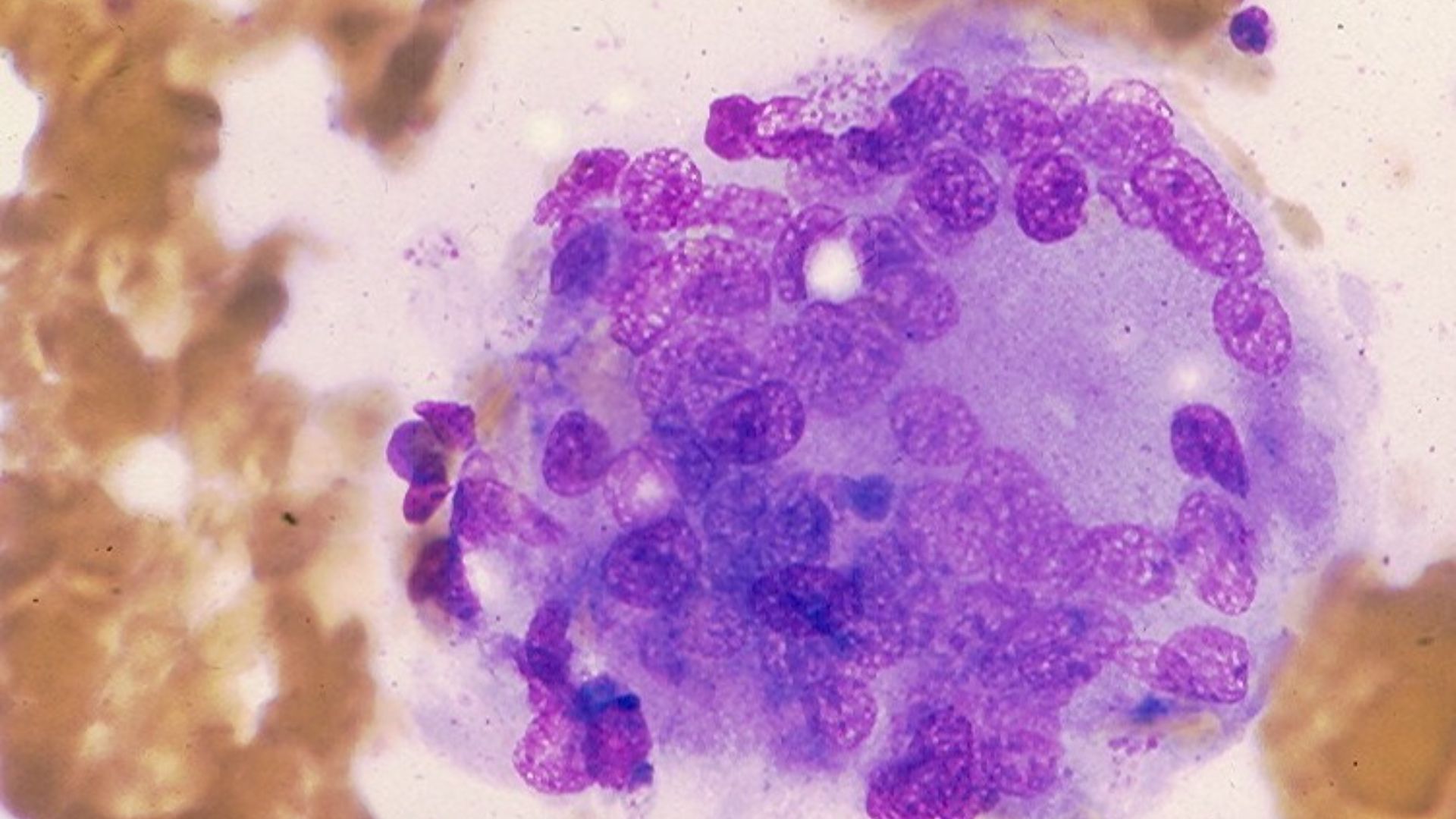 Mehrkernige Riesenzelle bei subakuter Thyreoiditis